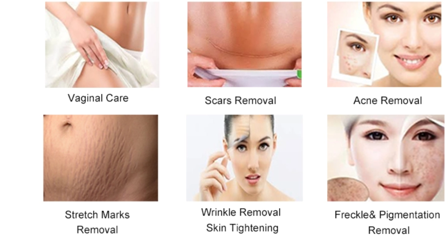 Co2 Fractional Laser Machine For Skin