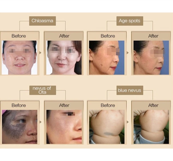Picosecond Tattoo Removal