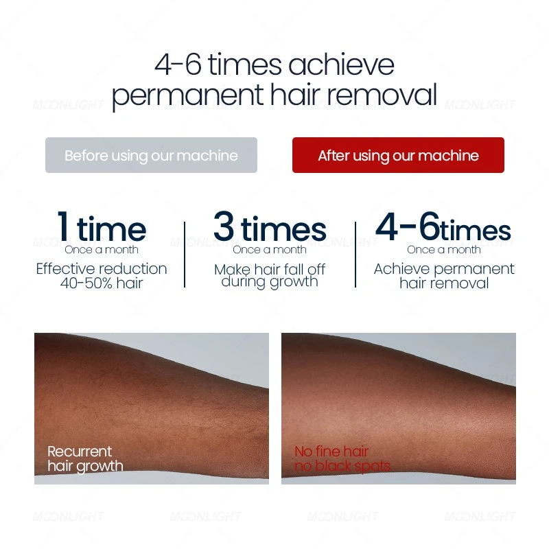 4 Wavelength Diode Laser Hair Removal Machine – Advanced Ice Cooling Technology For Professional Clinics & Beauty Centers price