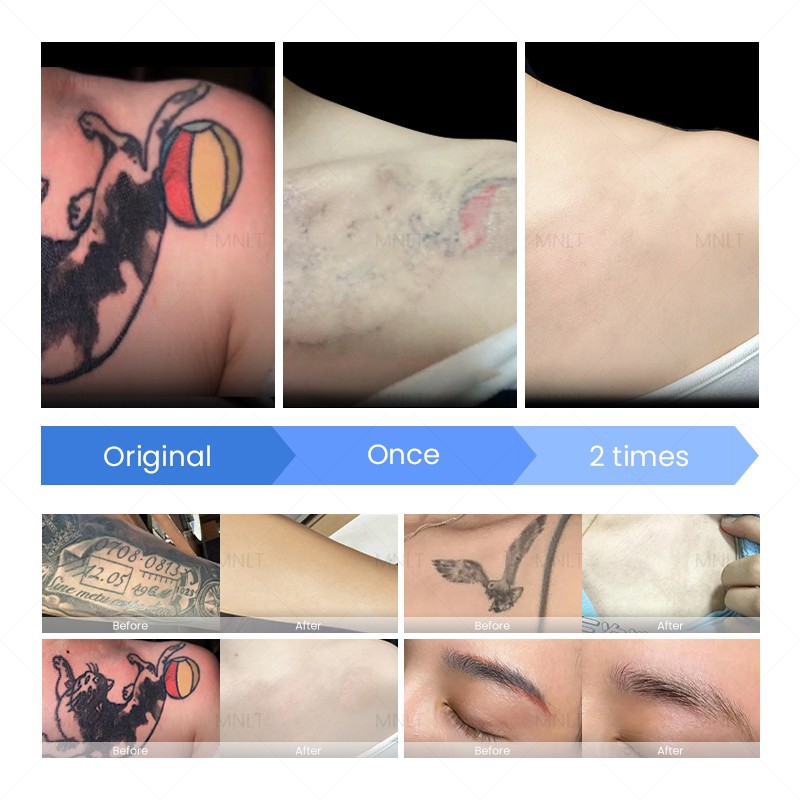 Portable Q-Switch ND YAG Laser Machine