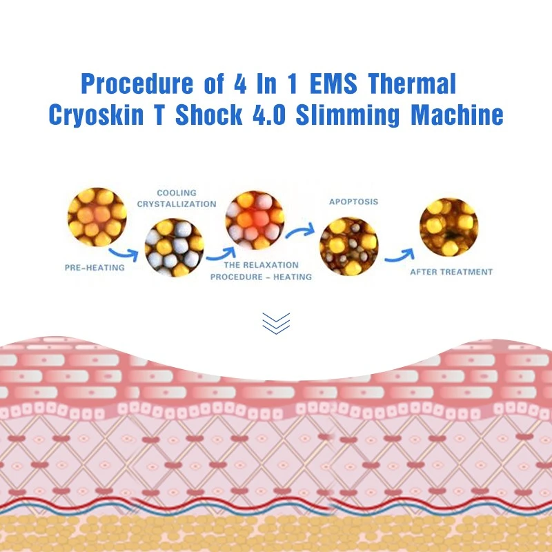 cryo slimming